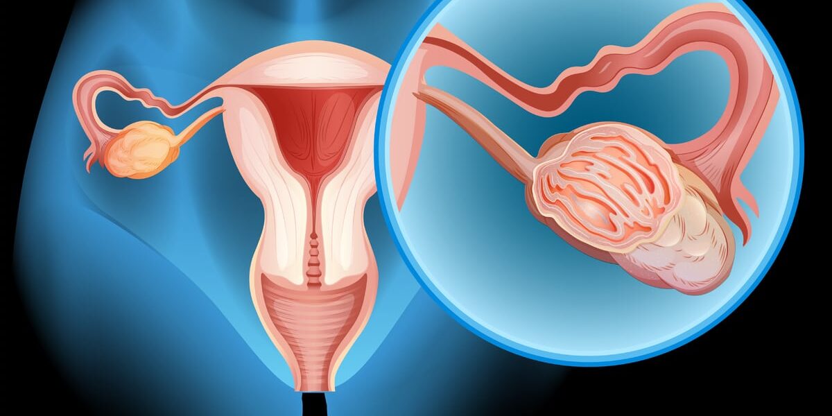 كيس المبيض كيس المبيض